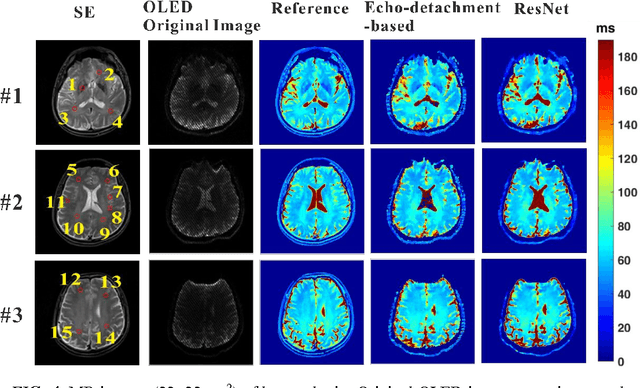 Figure 4 for High Efficient Reconstruction of Single-shot T2 Mapping from OverLapping-Echo Detachment Planar Imaging Based on Deep Residual Network