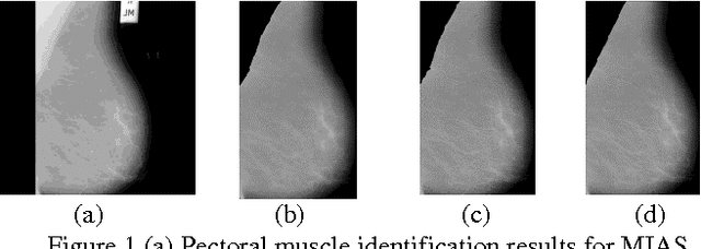 Figure 1 for Pectoral Muscles Suppression in Digital Mammograms using Hybridization of Soft Computing Methods