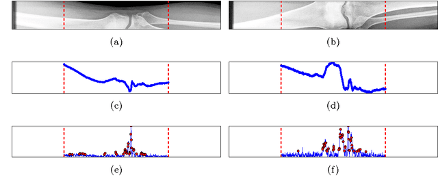 Figure 3 for A novel method for automatic localization of joint area on knee plain radiographs