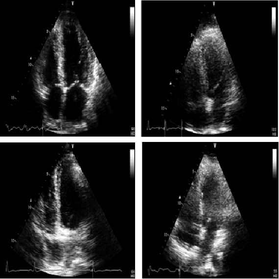Figure 2 for Early Detection of Myocardial Infarction in Low-Quality Echocardiography