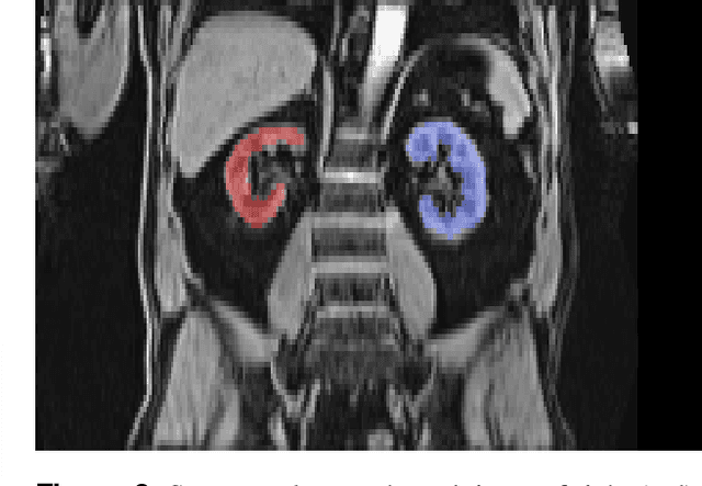 Figure 3 for Kidney segmentation in neck-to-knee body MRI of 40,000 UK Biobank participants