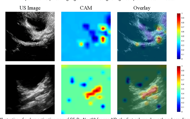 Figure 4 for Explainable Deep Learning Algorithm for Distinguishing Incomplete Kawasaki Disease by Coronary Artery Lesions on Echocardiographic Imaging