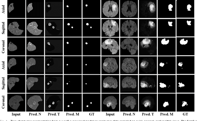 Figure 4 for Self-supervised Tumor Segmentation through Layer Decomposition