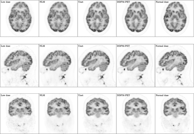 Figure 2 for PET image denoising based on denoising diffusion probabilistic models