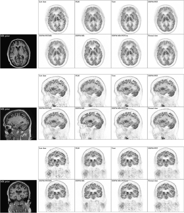 Figure 4 for PET image denoising based on denoising diffusion probabilistic models