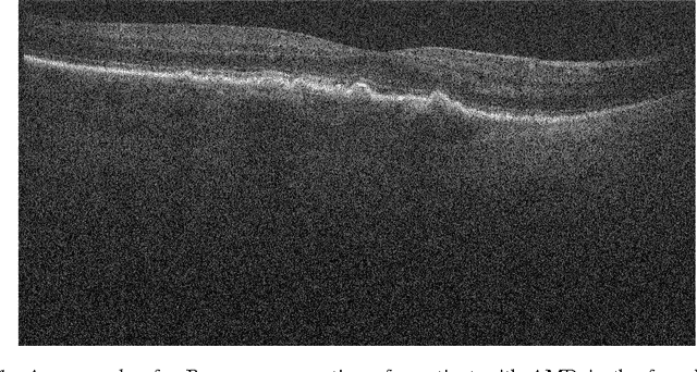 Figure 1 for RetiNet: Automatic AMD identification in OCT volumetric data