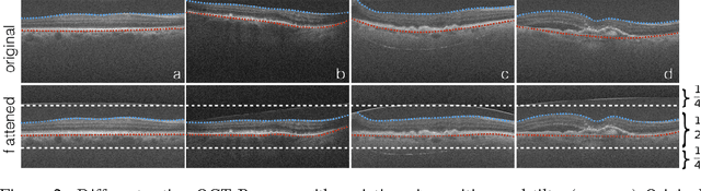 Figure 3 for RetiNet: Automatic AMD identification in OCT volumetric data