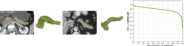 Figure 4 for Spatial Aggregation of Holistically-Nested Networks for Automated Pancreas Segmentation