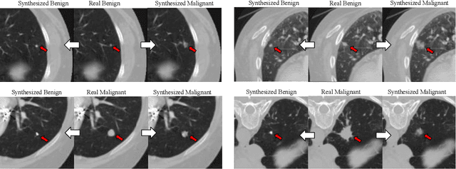 Figure 3 for Class-Aware Adversarial Lung Nodule Synthesis in CT Images