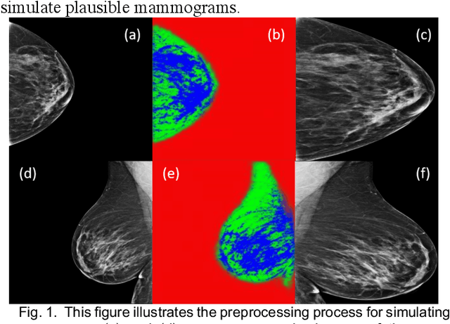 Figure 1 for Identifying Women with Mammographically-Occult Breast Cancer Leveraging GAN-Simulated Mammograms