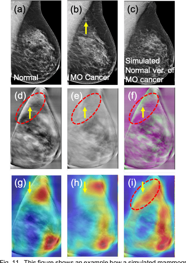 Figure 3 for Identifying Women with Mammographically-Occult Breast Cancer Leveraging GAN-Simulated Mammograms