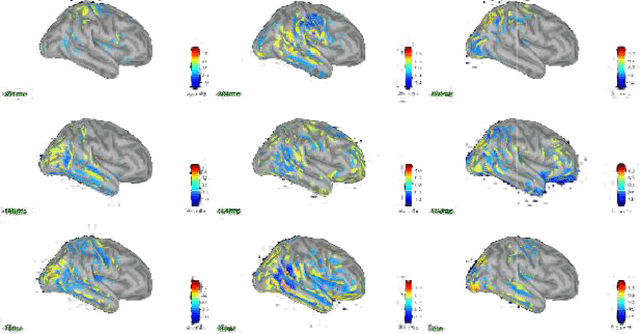 Figure 4 for Comparison of inverse problem linear and non-linear methods for localization source: a combined TMS-EEG study