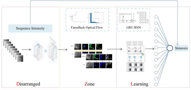 Figure 1 for Disarranged Zone Learning (DZL): An unsupervised and dynamic automatic stenosis recognition methodology based on coronary angiography