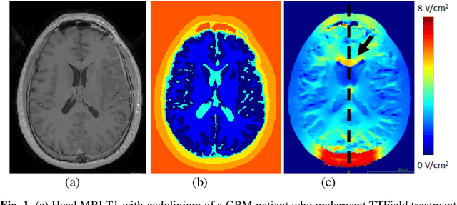 Figure 1 for A Method for Tumor Treating Fields Fast Estimation