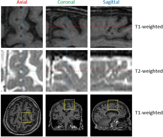 Figure 1 for Perivascular Spaces Segmentation in Brain MRI Using Optimal 3D Filtering
