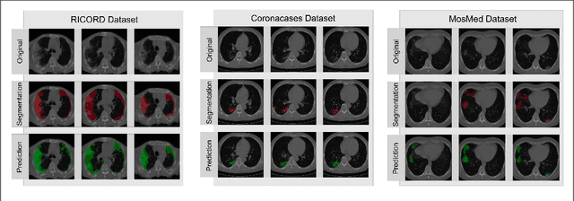 Figure 4 for 3D U-Net for segmentation of COVID-19 associated pulmonary infiltrates using transfer learning: State-of-the-art results on affordable hardware