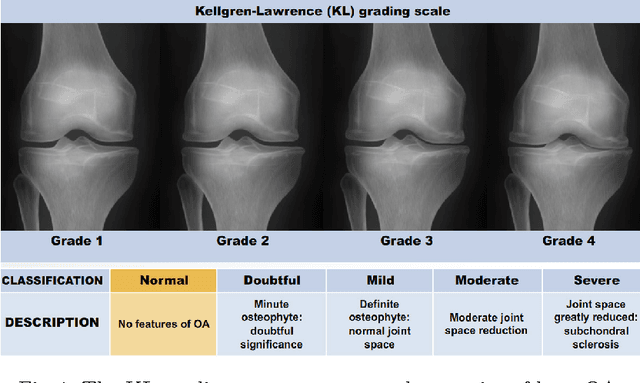 Figure 1 for Automatic Detection of Knee Joints and Quantification of Knee Osteoarthritis Severity using Convolutional Neural Networks