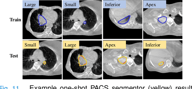 Figure 3 for One shot PACS: Patient specific Anatomic Context and Shape prior aware recurrent registration-segmentation of longitudinal thoracic cone beam CTs