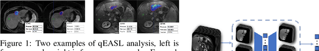 Figure 1 for Hepatocellular Carcinoma Intra-arterial Treatment Response Prediction for Improved Therapeutic Decision-Making