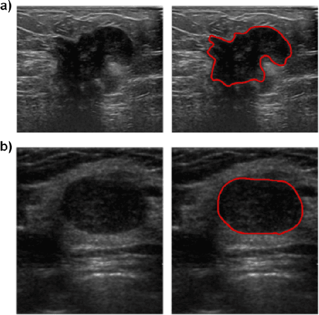 Figure 1 for Breast mass classification in ultrasound based on Kendall's shape manifold