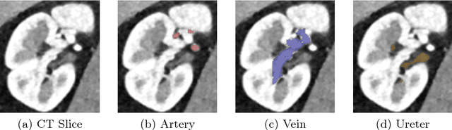 Figure 1 for Kid-Net: Convolution Networks for Kidney Vessels Segmentation from CT-Volumes