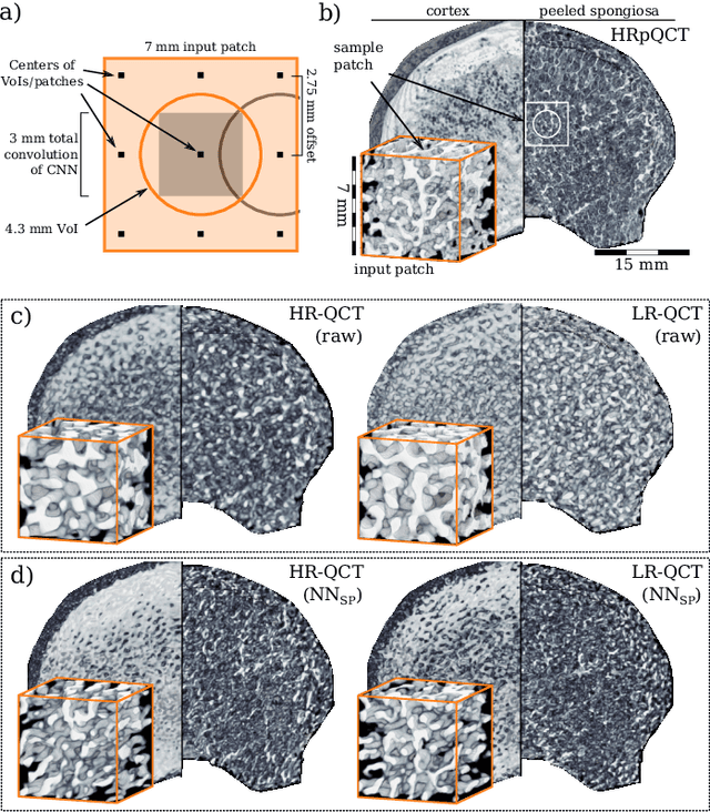 Figure 3 for Noise Reduction to Compute Tissue Mineral Density and Trabecular Bone Volume Fraction from Low Resolution QCT