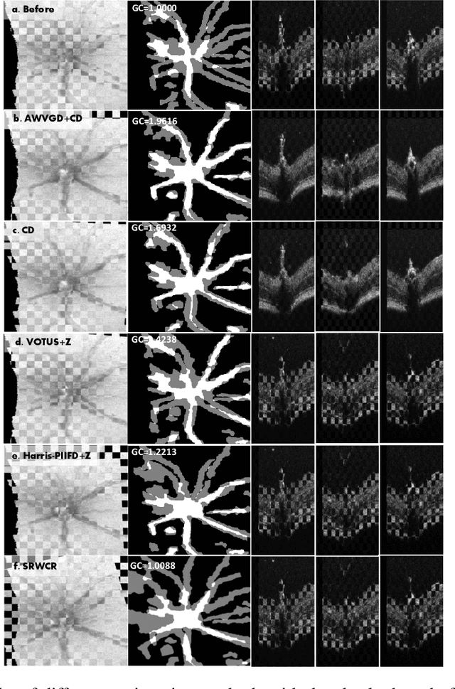 Figure 4 for Optimal Transport-based Graph Matching for 3D retinal OCT image registration