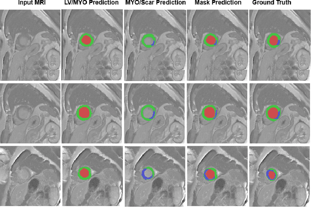 Figure 4 for Automatic Myocardial Infarction Evaluation from Delayed-Enhancement Cardiac MRI using Deep Convolutional Networks