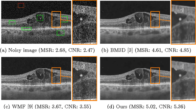 Figure 3 for QuaSI: Quantile Sparse Image Prior for Spatio-Temporal Denoising of Retinal OCT Data