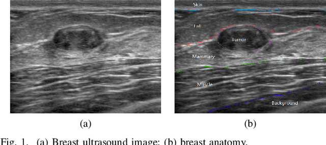 Figure 1 for Fuzzy Semantic Segmentation of Breast Ultrasound Image with Breast Anatomy Constraints