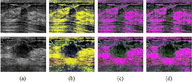 Figure 2 for Fuzzy Semantic Segmentation of Breast Ultrasound Image with Breast Anatomy Constraints