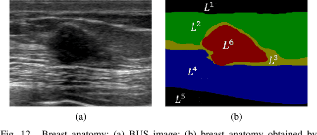 Figure 4 for Fuzzy Semantic Segmentation of Breast Ultrasound Image with Breast Anatomy Constraints