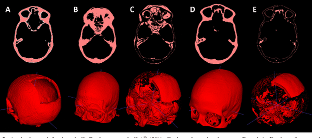 Figure 1 for Back to the Roots: Reconstructing Large and Complex Cranial Defects using an Image-based Statistical Shape Model