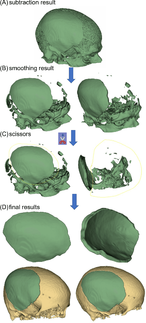 Figure 4 for Back to the Roots: Reconstructing Large and Complex Cranial Defects using an Image-based Statistical Shape Model