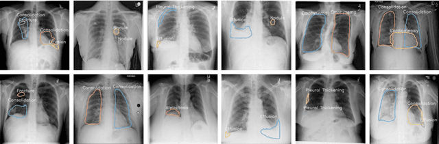 Figure 3 for A Structure-Aware Relation Network for Thoracic Diseases Detection and Segmentation