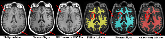 Figure 1 for Relevance Vector Machines for harmonization of MRI brain volumes using image descriptors