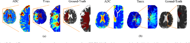 Figure 1 for Combining unsupervised and supervised learning for predicting the final stroke lesion