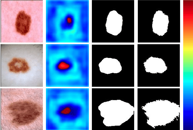 Figure 4 for Complementary Network with Adaptive Receptive Fields for Melanoma Segmentation