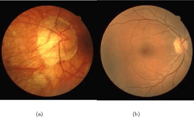 Figure 1 for A Two-phase Decision Support Framework for the Automatic Screening of Digital Fundus Images