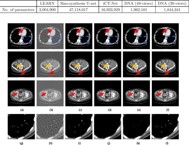 Figure 2 for Dual Network Architecture for Few-view CT -- Trained on ImageNet Data and Transferred for Medical Imaging