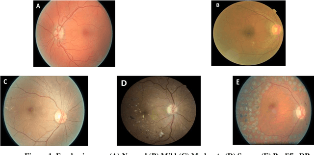 Figure 1 for Transfer Learning based Detection of Diabetic Retinopathy from Small Dataset