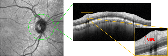 Figure 1 for Glaucoma Detection From Raw Circumapillary OCT Images Using Fully Convolutional Neural Networks