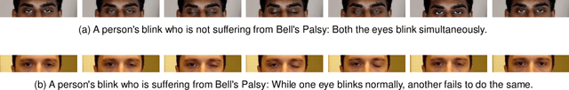 Figure 1 for Eye-focused Detection of Bell's Palsy in Videos