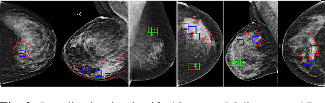 Figure 3 for Classification and Detection in Mammograms with Weak Supervision via Dual Branch Deep Neural Net