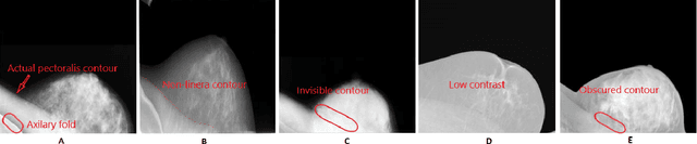 Figure 1 for On segmentation of pectoralis muscle in digital mammograms by means of deep learning