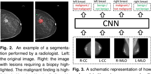 Figure 3 for Deep Neural Networks Improve Radiologists' Performance in Breast Cancer Screening