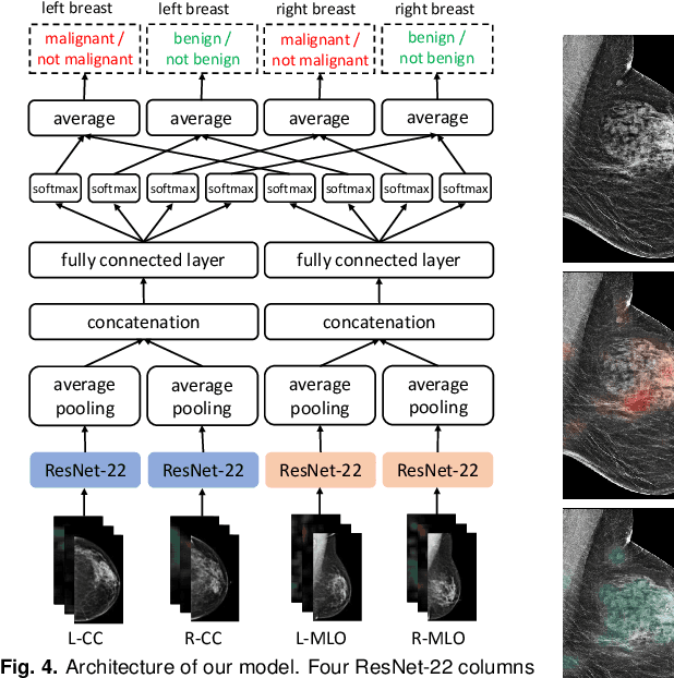 Figure 4 for Deep Neural Networks Improve Radiologists' Performance in Breast Cancer Screening
