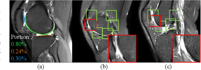 Figure 1 for Knee Cartilage Defect Assessment by Graph Representation and Surface Convolution