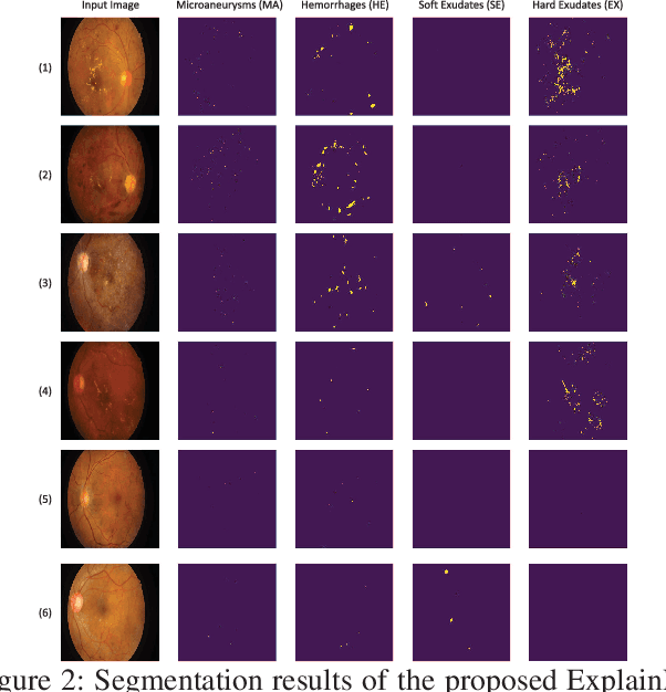 Figure 3 for Explainable and Interpretable Diabetic Retinopathy Classification Based on Neural-Symbolic Learning