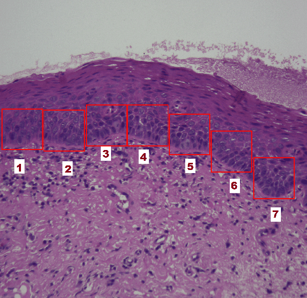 Figure 1 for A Pathology-Based Machine Learning Method to Assist in Epithelial Dysplasia Diagnosis